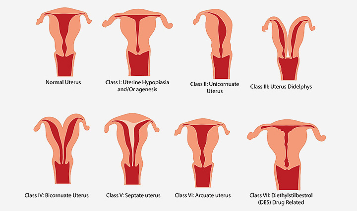 Abnormal Uterus